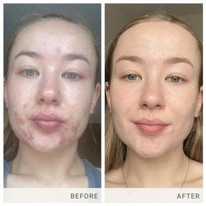 jane iredale Skin Accumax Nutritional Supplement Capsules Improve Acne & Promote Healthy Skin Contains Vitamin A, C and E Vegan & Gluten-Free