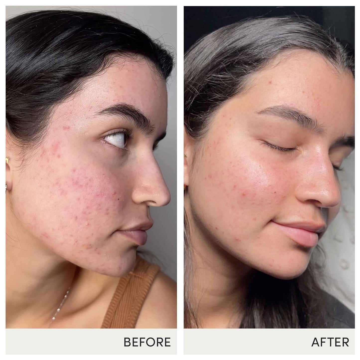 jane iredale Skin Accumax Nutritional Supplement Capsules Improve Acne & Promote Healthy Skin Contains Vitamin A, C and E Vegan & Gluten-Free