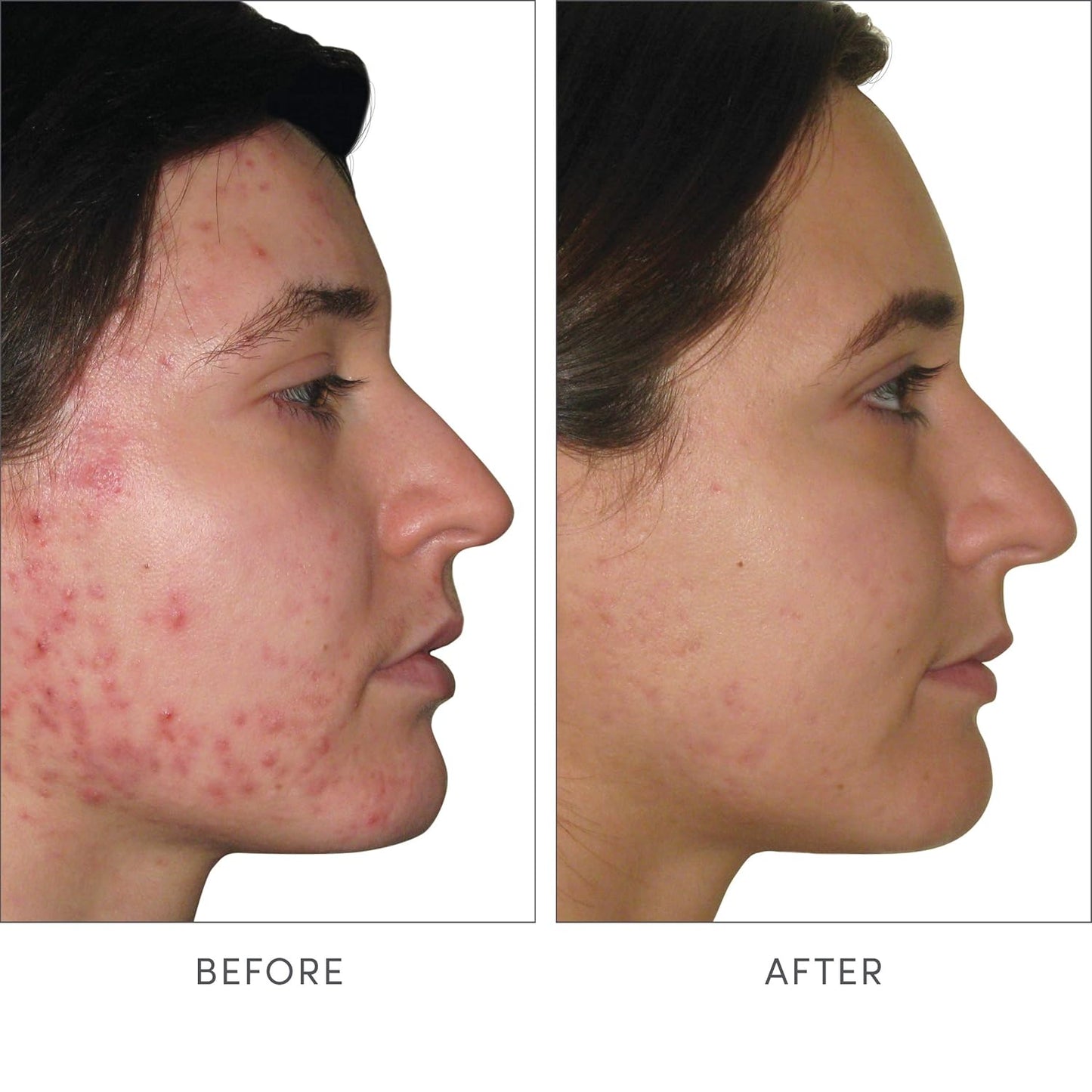 jane iredale Skin Accumax Nutritional Supplement Capsules Improve Acne & Promote Healthy Skin Contains Vitamin A, C and E Vegan & Gluten-Free
